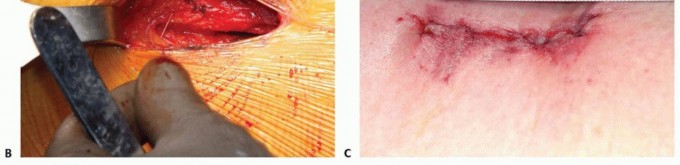 Illustration 43 for Anterior FAI Relief: Mini-Open Anterior Approach Explained