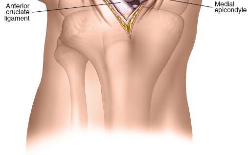 Illustration 82 for Optimal Femoral Approaches: Mastering the Lateral Intermuscular Septum