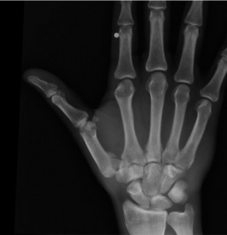 Illustration 15 for Christine M Kleinert Discussion: Solving Difficult Wrist Fractures