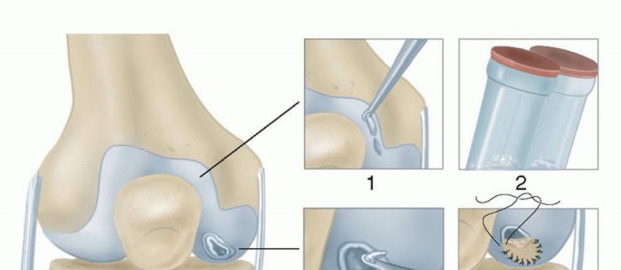 Illustration of articular cartilage lesion - Dr. Mohammed Hutaif