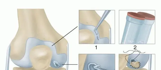 زرع الغضاريف الذاتي (ACI): دليل شامل لاستعادة حركتك وحياتك بلا ألم في اليمن مع الأستاذ الدكتور محمد هطيف