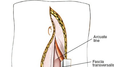 Illustration 86 for Approach to the Lumbar Spine: Mastering Techniques & Anatomy