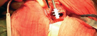 Illustration 17 for Cemented Femoral Stem Figures: Surgical Anatomy & Placement