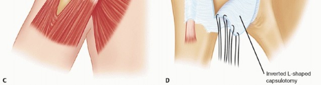 Illustration 16 for Glenoid Bone Graft for Anterior Shoulder Instability: Restore Stability