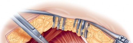 Illustration 39 for Direct Lateral Hip: Optimize Exposure with Sharp Curved Hohmann