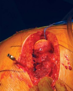 Illustration 65 for Metal on Metal Resurfacing: Enhanced Posterior Soft Tissue Repair