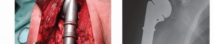 Illustration 23 for Restore Vital Function: Surgery for Type II Humeral Metastasis