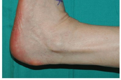 Illustration 24 for Restore Movement: Tendon Transfer for Common Peroneal Nerve Foot Drop