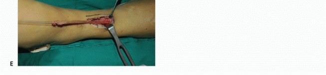 Illustration 46 for Foot Drop Surgery: How a Pin or Drill Elevates Tendon Transfer