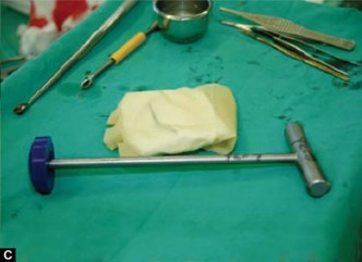 Illustration 19 for Optimizing Acetabular Component Cementation for Superior Outcomes