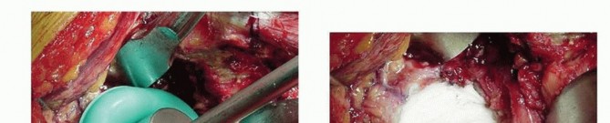 Illustration 11 for Cemented Total Hip: A Successful & Evidence-Based Solution