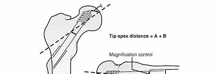 Managing Intertrochanteric Fractures with Unstable Patterns