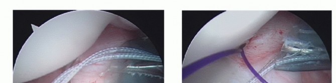 Illustration 6 for Mastering the Treatment of Recurrent Posterior Shoulder Instability