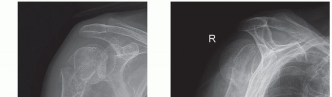 Illustration 3 for Hemiarthroplasty for Proximal: Effective Treatment for Fractures