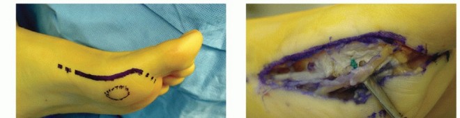 Illustration 18 for Restore Your Foot: Surgical Treatment for Hallux MP Joint Turf Toe