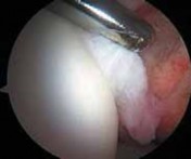 Illustration 39 for Solving Hip Soft Tissue Pathology with Advanced Arthroscopy