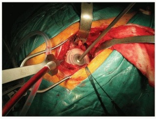 Illustration 23 for Cemented Acetabular Component: Achieving Optimal THA Stability