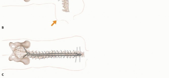 Illustration 10 for Duchenne Muscular Dystrophy: Is Spinal Fusion the Answer?