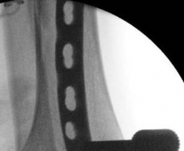 Illustration 25 for Tibial Fracture Extending into the Plafond: Intramedullary Secrets