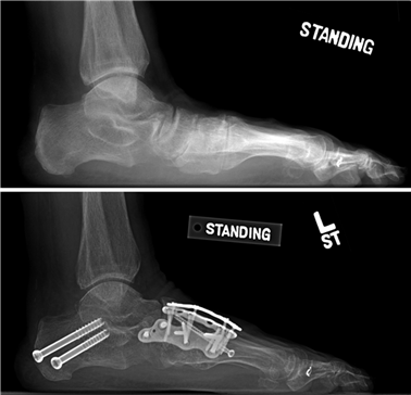 Illustration 45 for First Metatarsal Surgery: Expert Solutions for Foot & Ankle Pain