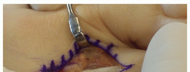 Illustration 20 for Hammer Toe Correction: Understanding the Extensor Digitorum Longus