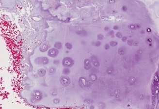 Illustration 8 for Diagnostic Dilemma: Unpacking Oncology Cases Enchondroma
