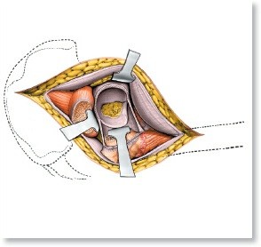 Illustration of aspect of the hip - Dr. Mohammed Hutaif