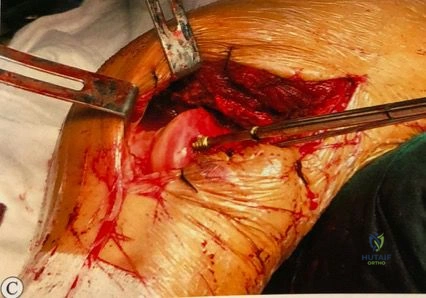 Distal Clavicle Fractures: Diagnosis, Treatment, and Complications