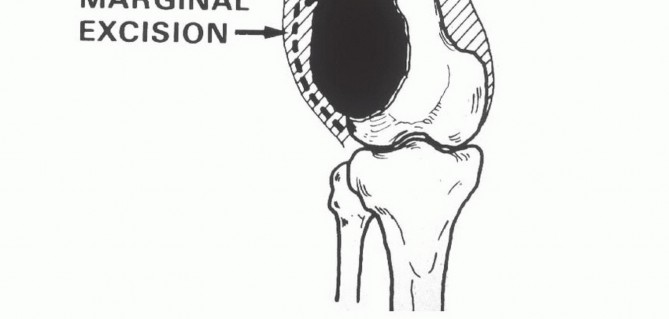 Illustration 20 for Advanced Distal Femoral Resections: Limb-Sparing Outcomes & Techniques