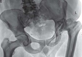 Illustration 37 for The Proxima: Why This Proximally Loading Implant Preserves Bone