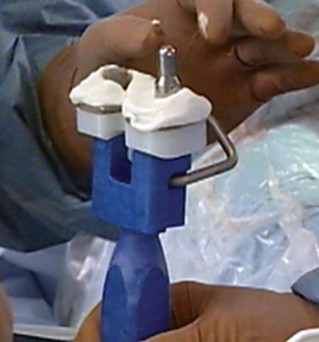 Illustration 13 for Monoblock Total Knee: When to Use & What to Avoid