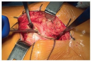 Illustration 3 for Unlock Precision: The Direct Lateral Approach for THA