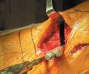 Illustration 35 for Guide Pin Assembly: Key to Flawless Upper Tibial Osteotomy