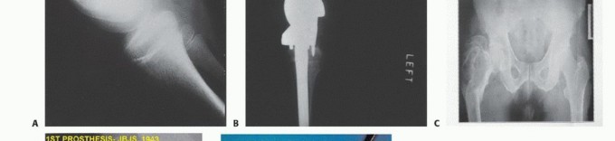 Illustration 2 for Distal Femoral Replacement: Key to Modern Limb Salvage