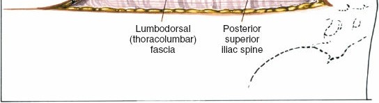 Illustration 12 for Pelvis & Acetabulum Approaches: Unlocking the Posterior Superior Iliac