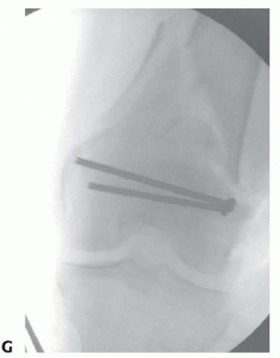 Illustration 71 for Repairing Distal Femur Fractures: Open Reduction & Internal Fixation