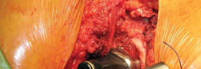 Illustration 48 for Kinectiv® Stem: Modular Necks for Primary THA Success