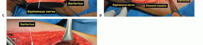 Illustration 28 for Advanced Distal Femoral Resections: Limb-Sparing Outcomes & Techniques