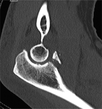 Illustration 3 for Complex Elbow Dislocation: Demystifying the Posteromedial Case