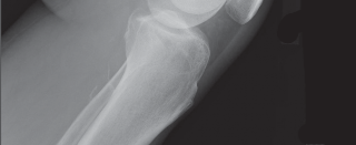 Illustration 7 for Cemented TKA Figure: Your Visual Guide to Surgical Success