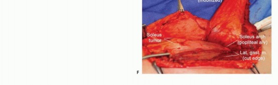 Illustration 8 for Soleus Resection for Tumors: Protecting the Heads of the Gastrocnemius