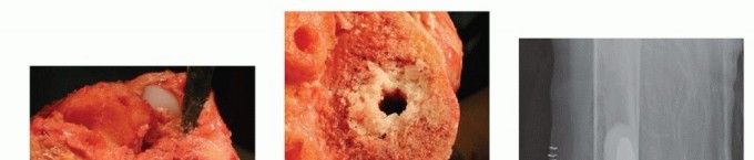 Illustration 3 for Bone Loss Bone Grafting for Challenging Tibial Defects