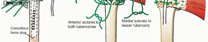 Illustration 29 for Hemiarthroplasty for Proximal: Effective Treatment for Fractures