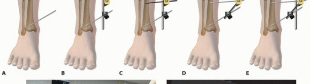 Illustration 31 for Tibia External Fixation: See How Pins Are Placed for Healing