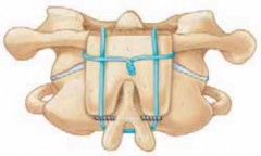 Illustration 23 for Cervical Fusion: The Line is Drawn for Lasting Stability