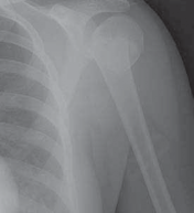 Illustration 3 for Mastering Pediatric Shoulder Fractures: Clinical Insights