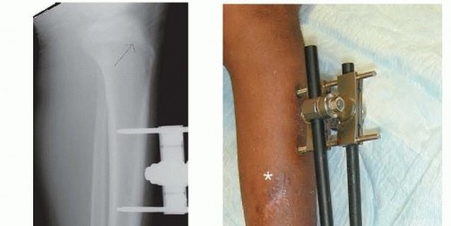 Illustration 6 for Optimal Treatment for Pediatric Tibial Fractures: Key Insights