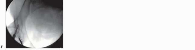 Illustration 25 for Emergency Fixation of the Pelvis: Control Bleeding & Restore Stability