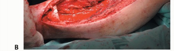 Illustration 17 for Free Vascularized Fibular Grafts: Solving Complex Bone Defects