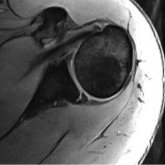 Illustration 4 for Pinpoint Posterior GH Instability: Diagnosis & Causes